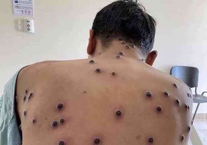 Mpox virus