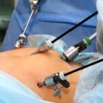 Cirurgia bariátrica gratuita