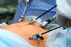 Cirurgia bariátrica gratuita